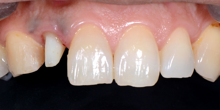 審美歯科の症例