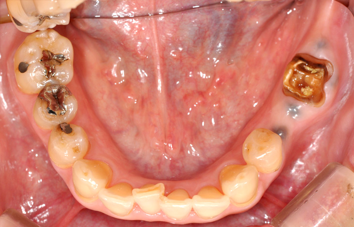 インプラントの症例
