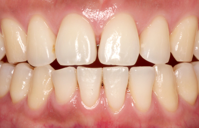 予防歯科の症例