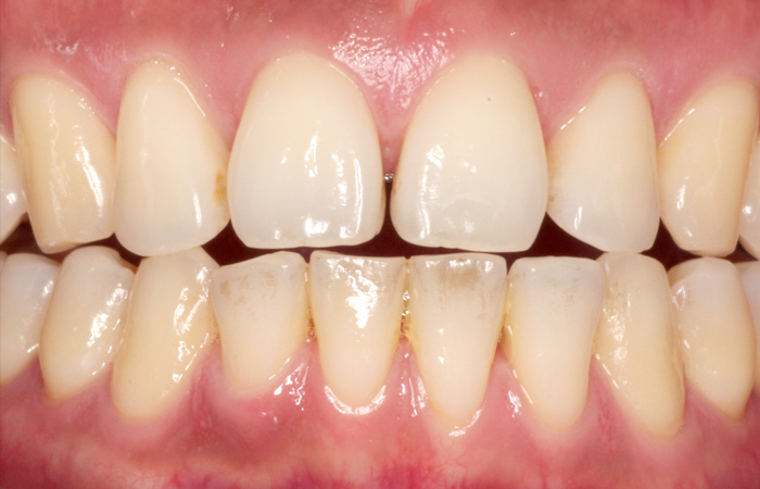 予防歯科の症例